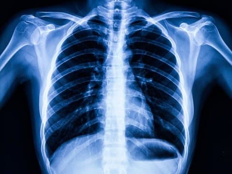 Digital chest X-ray showing the ribcage and lungs